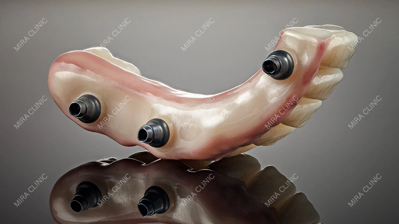 Abutments and Prosthetic Components